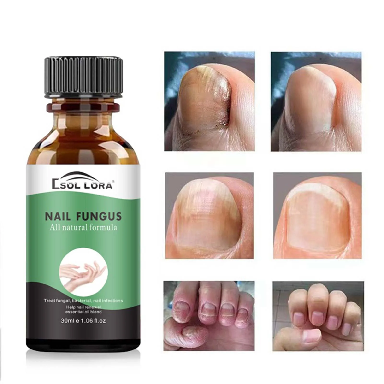 Nail Toenails Care Serum Effective Remove Onychomycosis Nail Repair Liquid for Broken Cracked Split and Weak Nails