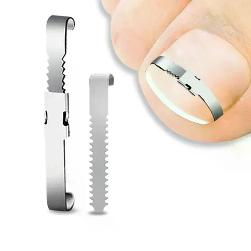 Ingrown Toenail Cor…