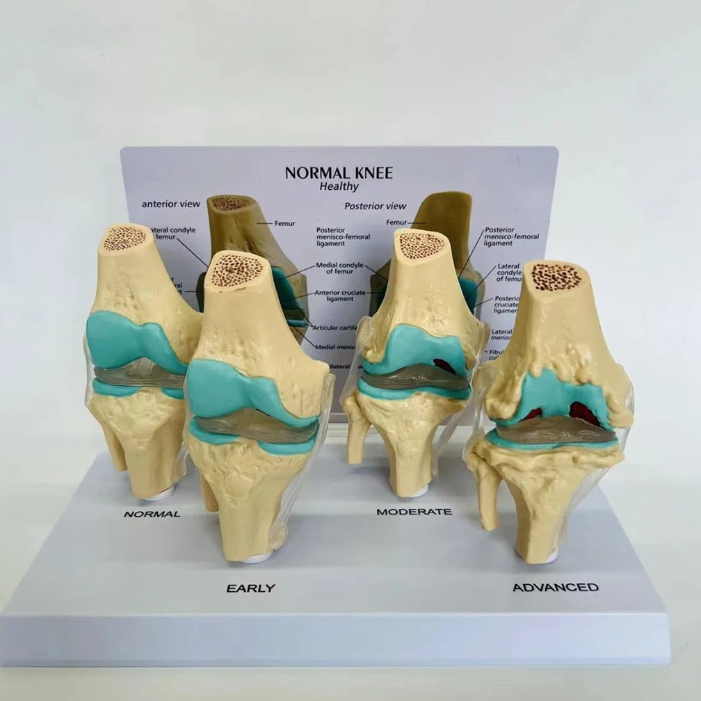 

Anatomical Human Degenerative 4-stage Knee Joint Disease Model PVC Bone Medical Skeleton Anatomy Teaching Resources ﻿Wholesale