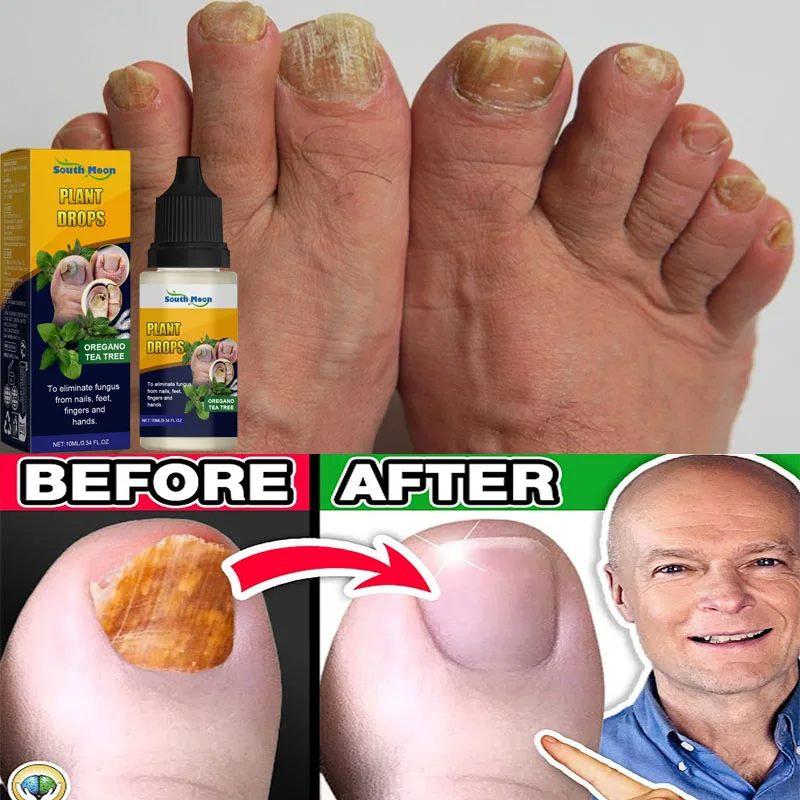 7 أيام علاجات فطريات الأظافر مصل سائل مضاد للعدوى فطار الداحس العناية باليدين الأظافر جل إزالة فطريات القدم #1