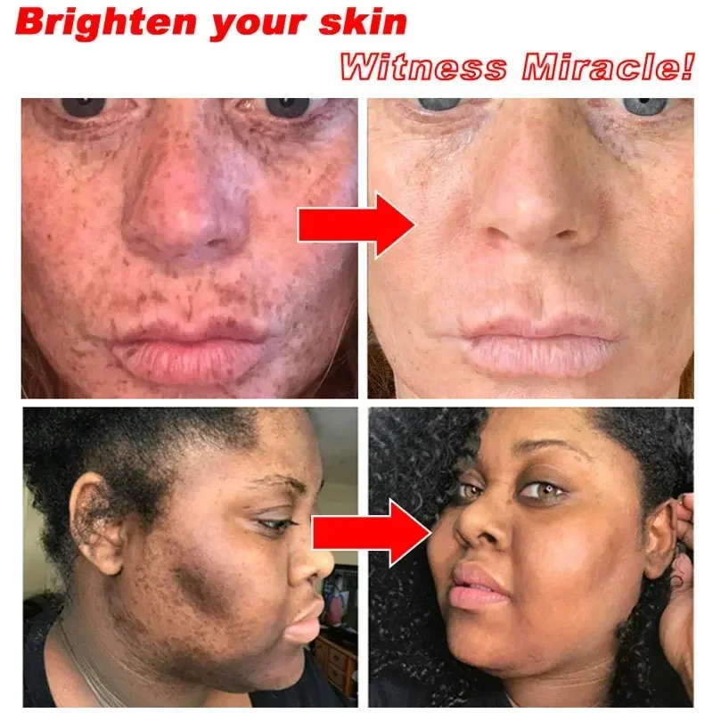 Niacinamide Whitening Freckle Cream Effectively Lightens Black Spots Acne Marks Removes Melasma Brightens Healthy Skin Mild