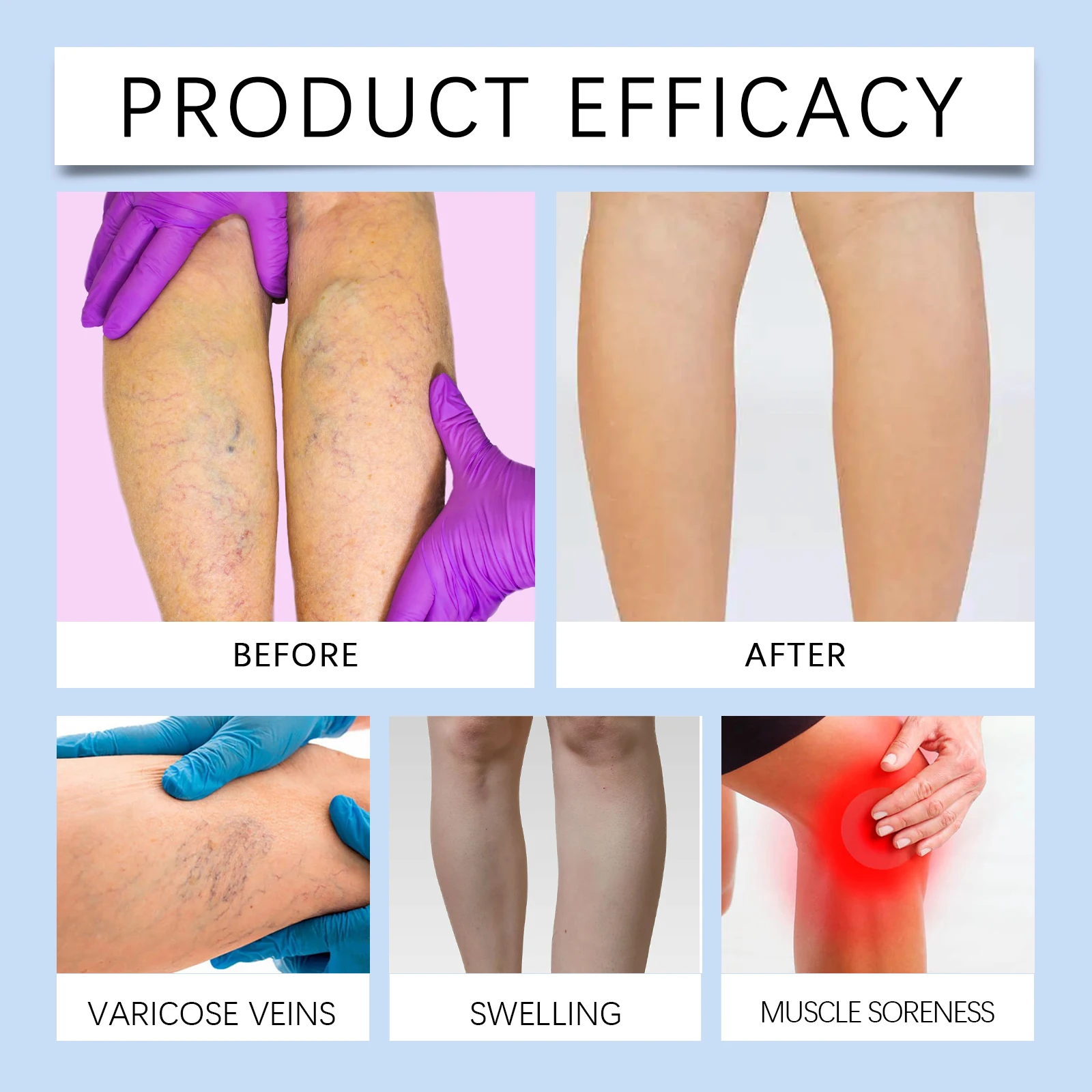 Varicose Veins Treatment Cream Instant Soothe Leg Fatigue Swelling Improve Blood Flow Prevent Blockage Spider Vein Relief Balm