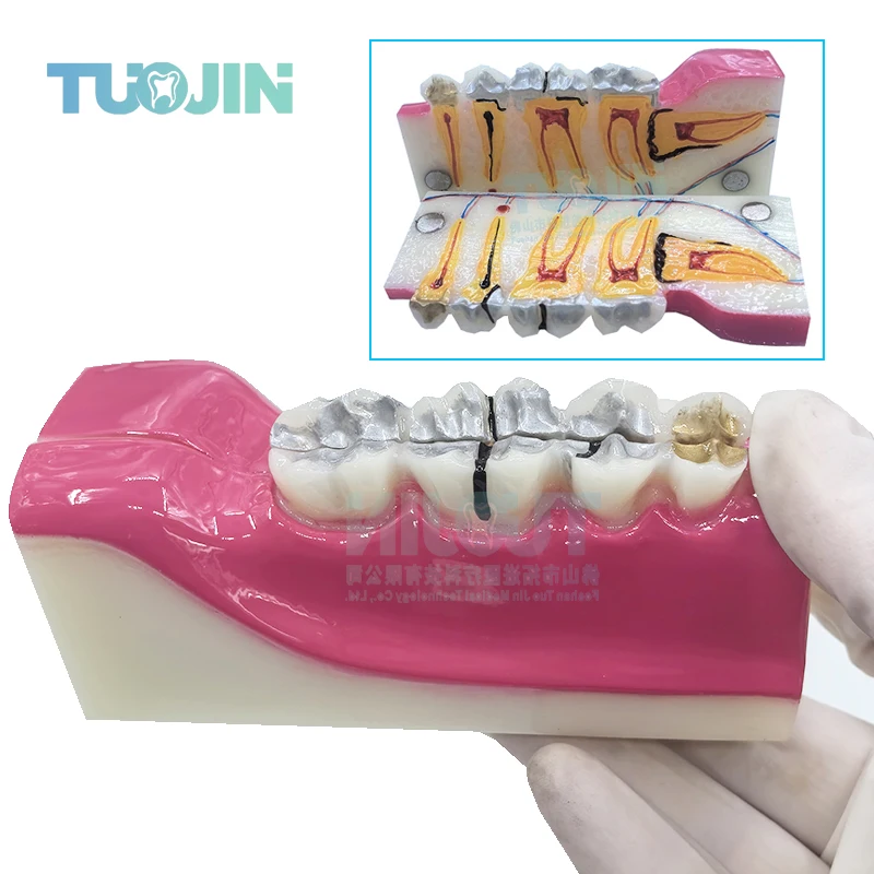 Dental Teaching Model Repair Pathological Impacted Tooth Model Pulp for Dentist Teaching and Training Dental Magnet Dentistry