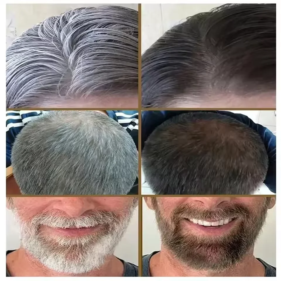 

Gray White Hair Treatment Serum Cover White Hair To Black Natural Color Repair Anti Loss Hair Restore Healthy HairCare Men Women