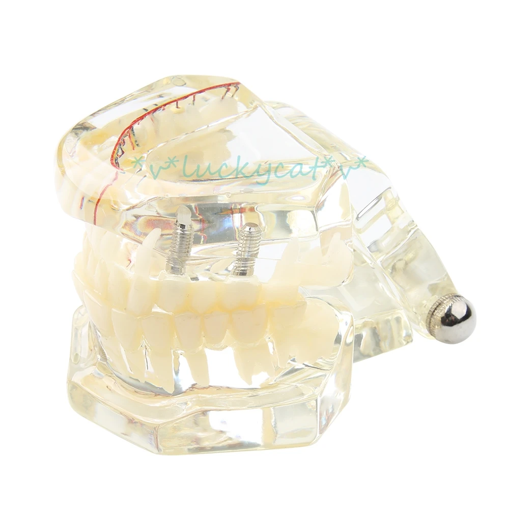 New 1pcs Dental Transparent Teaching Teeth Model Implant with Nerve Pathological Repair Teaching demonstration model for dentist