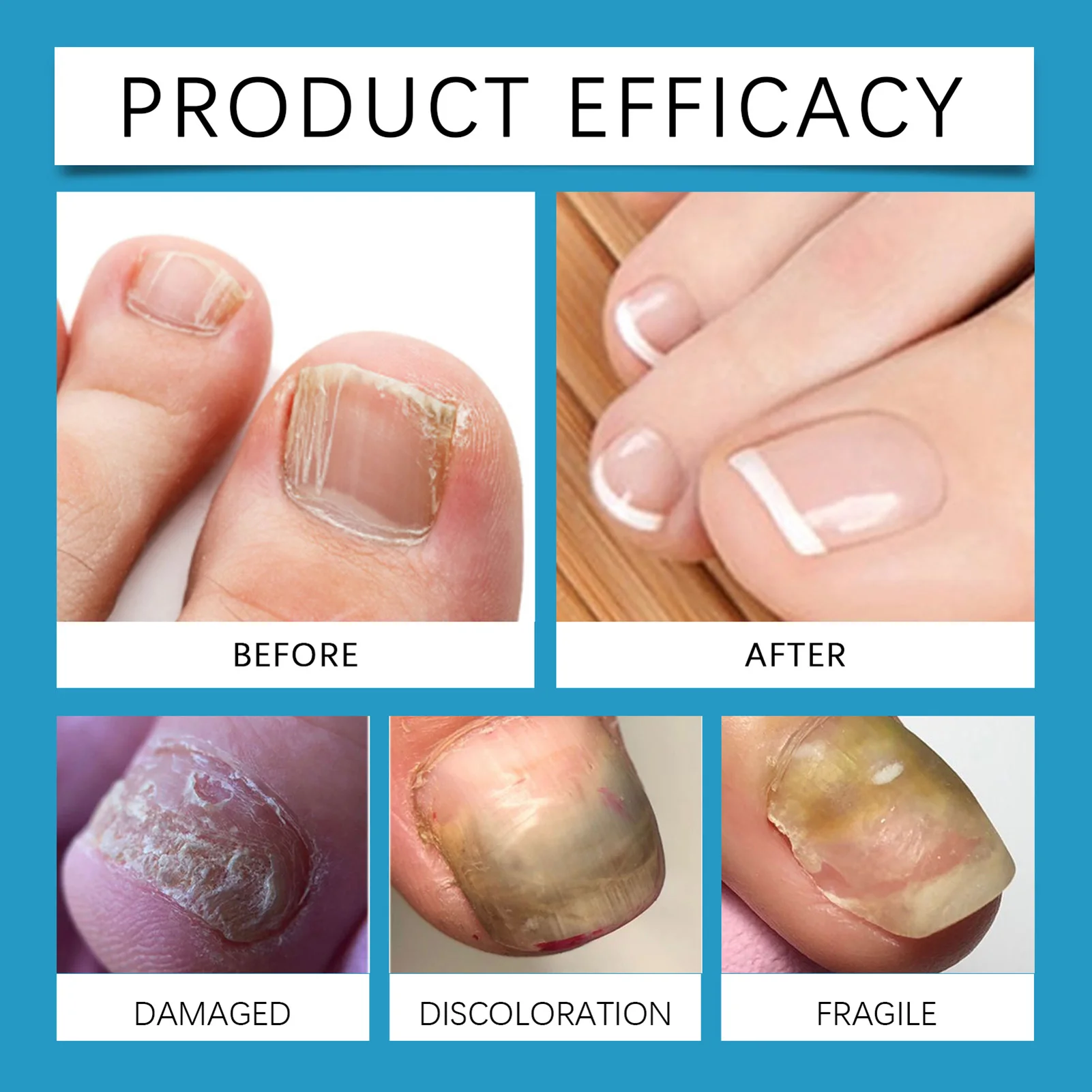 น้ำยาสำหรับรักษาเชื้อราที่เล็บเท้าขนาด 30 มล. ส่วนผสมจากธรรมชาติที่อ่อนโยน น้ำยาป้องกันเชื้อราที่เล็บสำหรับซ่อมแซมเล็บ