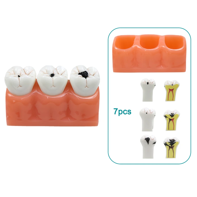 

4 Times Caries Comparation Model Dental Caries Teeth Model Removable Learning Study Model Dental Materials