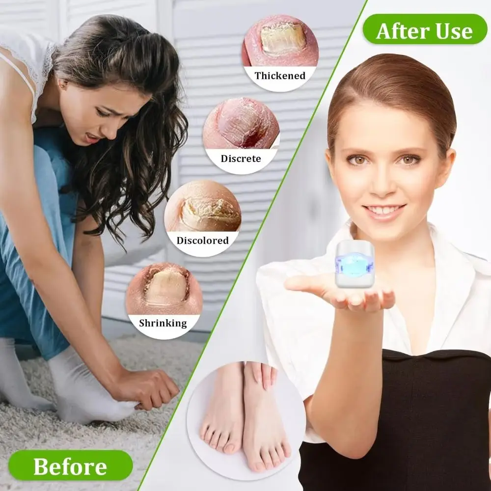 High Definition Display Nail Fungus Care Lamp Soft LED UV Light Lightweight Compact Nail Repair Tool USB Rechargeable