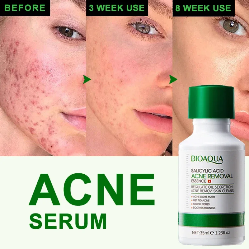 

Salicylic Acid Acne Removal Serum Treatment Acne Product Shrink Pore Remove Blackheads Facial Cleaning Fade Acne Marks Whitening