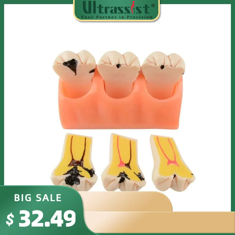 Ultrassist Dental Caries Teeth 4 Times Dental Tooth Decay Model Caries Bilateral Comparison Pathology Model Teeth