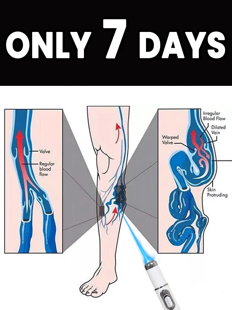 

Portable vascular blue light pen: Reduces varicose veins and broken capillaries