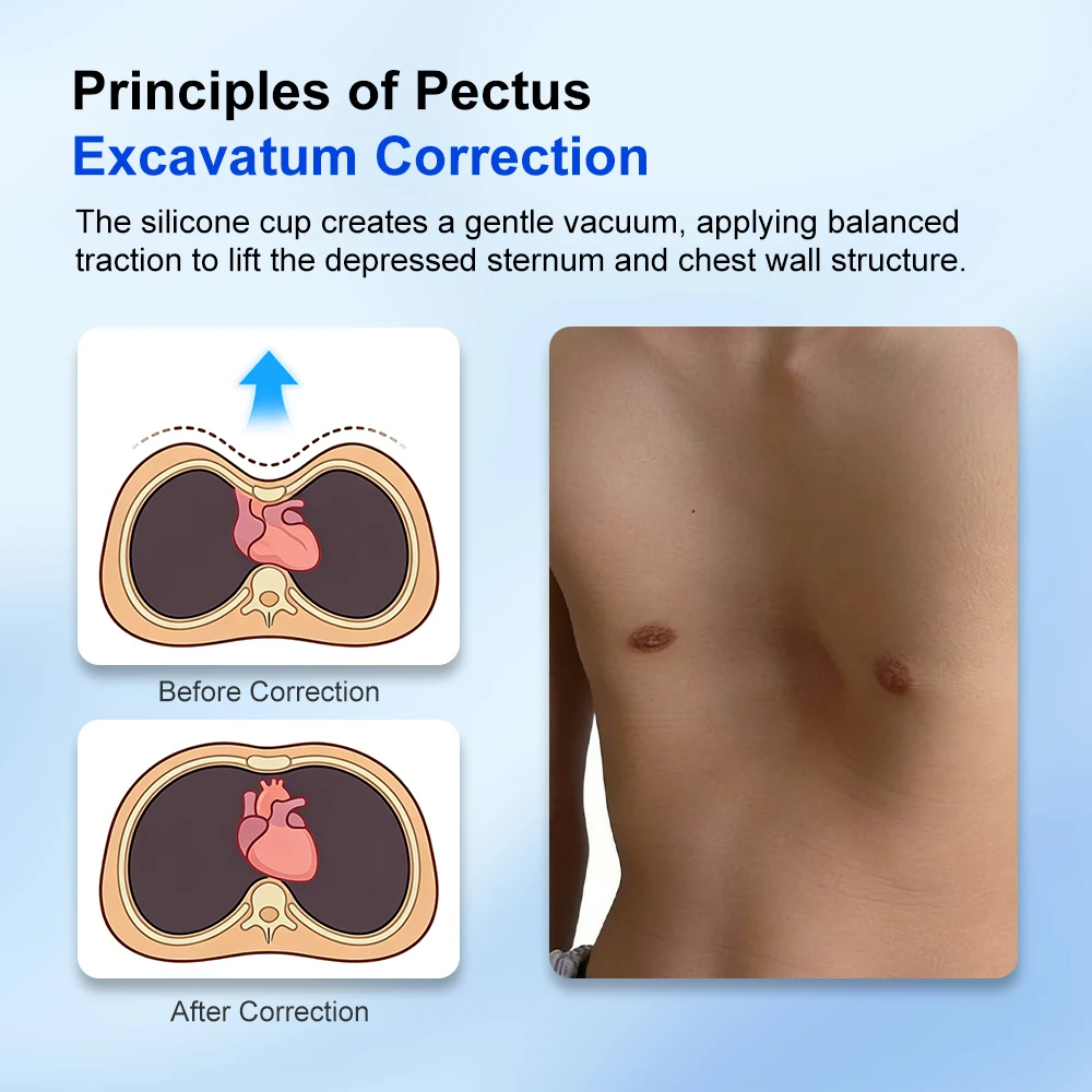 Pectus Excavatum Vacuum Bell with Automatic Pump Pectus Excavatum Orthosis Brace for Sunken Chest Thoracic Depression Support