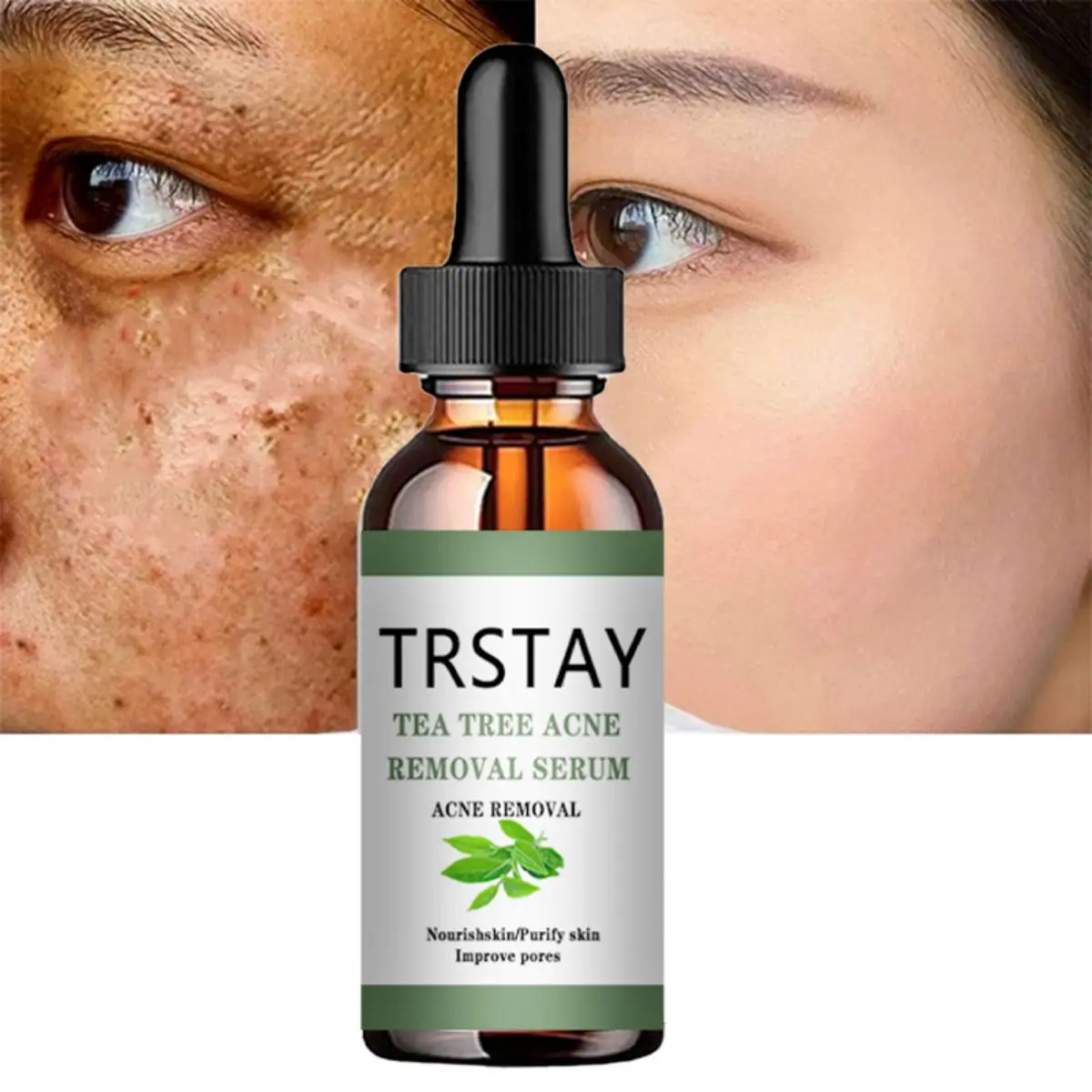 

TRSTAY Tea Tree Acne Essence Питательная очищающая кожа, улучшающая поры - крем для тела для мам и детей, беременных и беременных