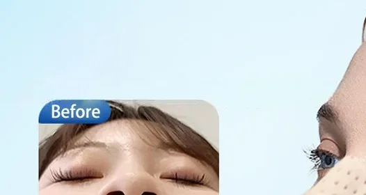 Low Temperature Thermoplastic Nose Splint Nose Job Rhinoplasty Splint Ortho Immobilized Thermoplastic Nose Nasal Fracture Splint