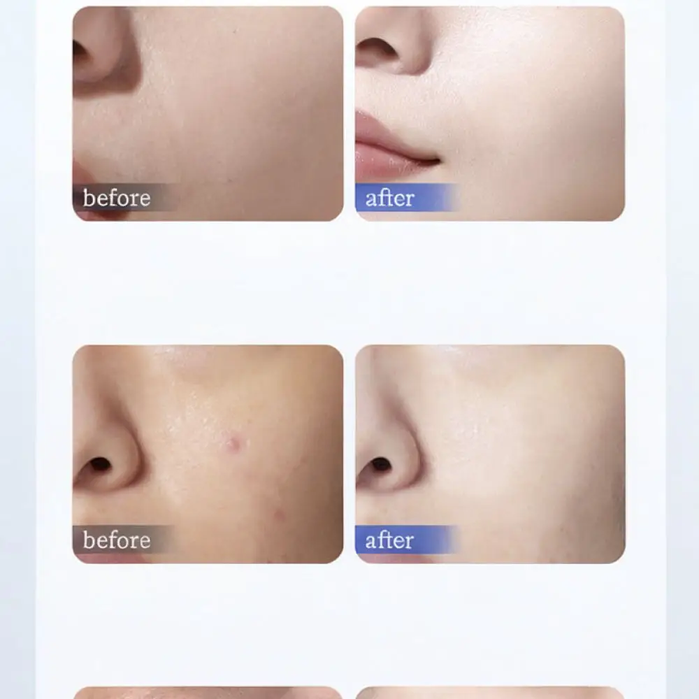 Whitening Cream For Qingliya 377 Dark Spot Remover Face Moisturizer Melasma Treatment Pigmentation Corrector Skin Care