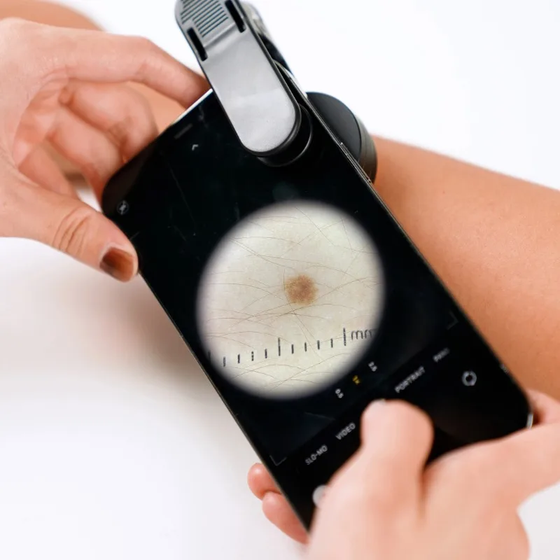 For DE-300 6X Smartphone Skin Observation Lens, Portable Dermatoscopic Skin Surface Imaging Accessory