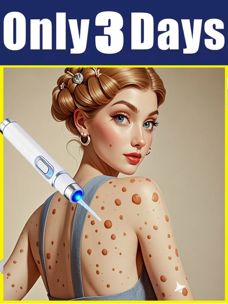 

2025 New Upgrade Blue Laser Solve Wart Tool