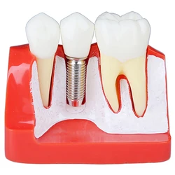 1 sztuk 4 razy Model zębów Dental Implant zęby Implant analiza korona most wymienny Model dentysta demonstracja naucz narzędzia