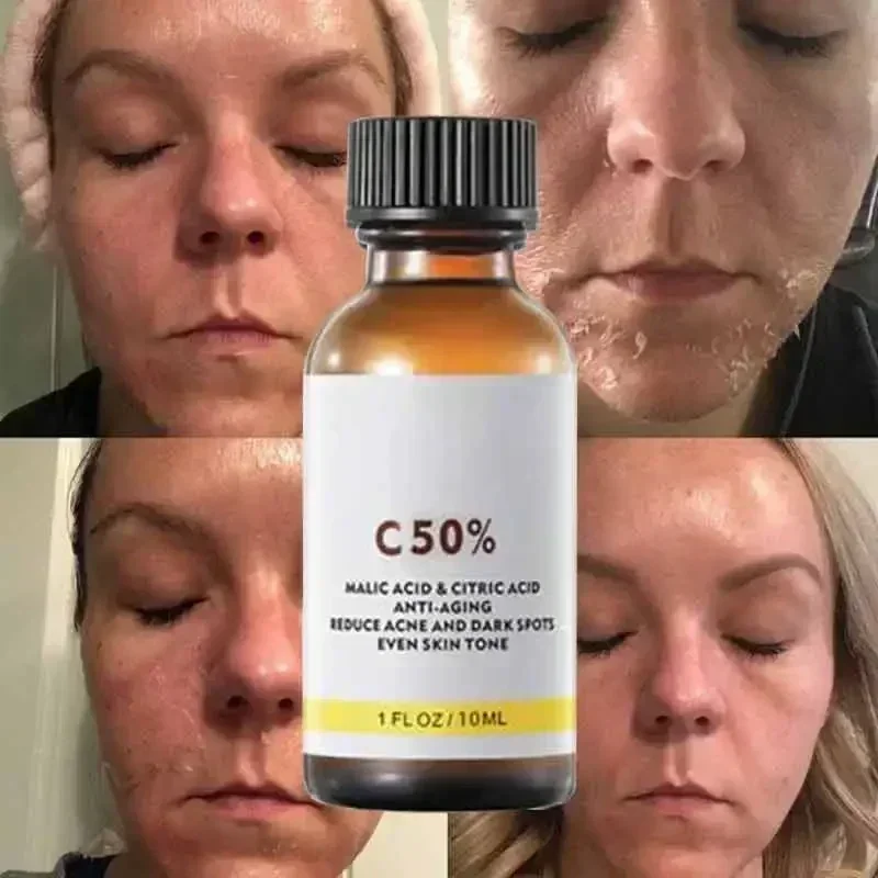 Avec acide malique et acide citrique pour le visage Peel 40% Sérum Peeling Peeling Sérum Peeling Peel chimique Essence nourrissante blanchissante