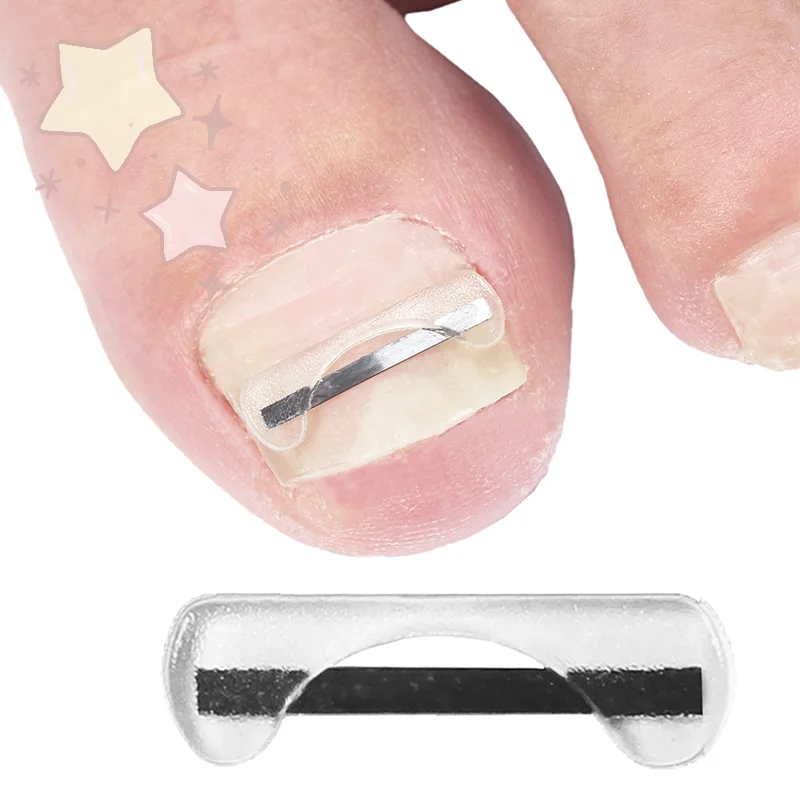 سلك تصحيح أظافر القدم من سبائك التيتانيوم لعلاج الأظافر نام مع ملصقات أداة السيليكون ملحقات العناية بالقدم