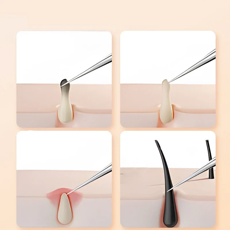 3/5pcs Cell Pimples Blackhead Clip Standard Stainless Steel Tweezers Ultra-fine Blackhead Remover Cleaning Milia Pimple Needle