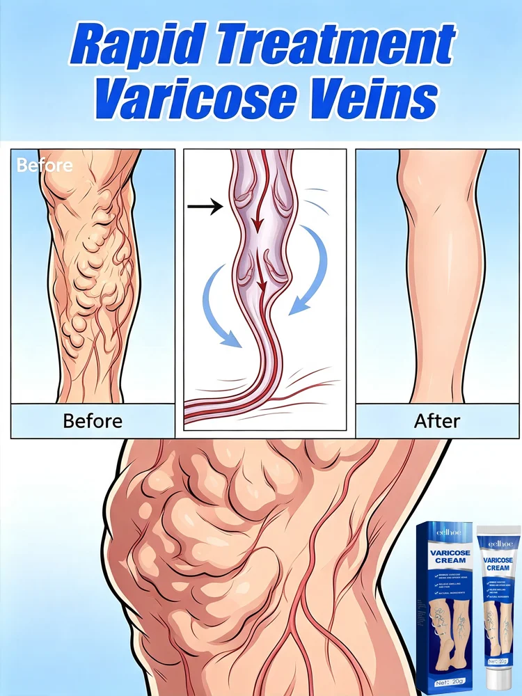 New Upgraded Version of The Second Generation Tool Blue Light Laser Repair Varicose Veins