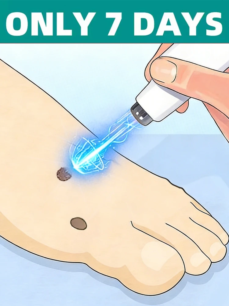 

Ручка-лазер с синим светом 2026 для удаления бородавок без вредных последствий и разрушения тканей