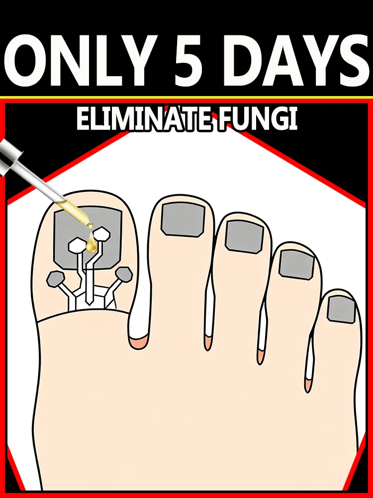 2025 يستحق الاستثمار في 100% معالجة فطريات الأظافر 5 أيام #1