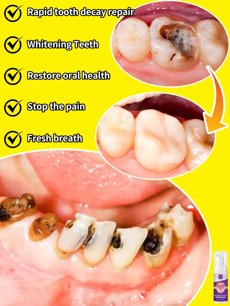 Hot selling dental products for tooth decayrepair and prevention