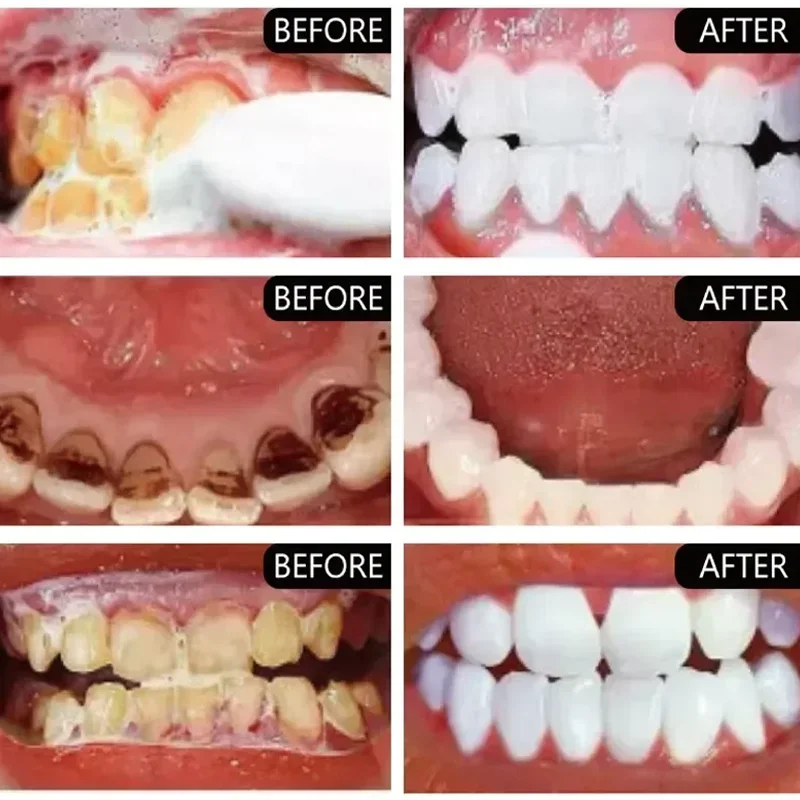 Soro de clareamento dental eficaz, removedor de manchas de placa, remoção de manchas de dente amarelo, hálito fresco, limpeza dental oral, cuidados de branqueamento