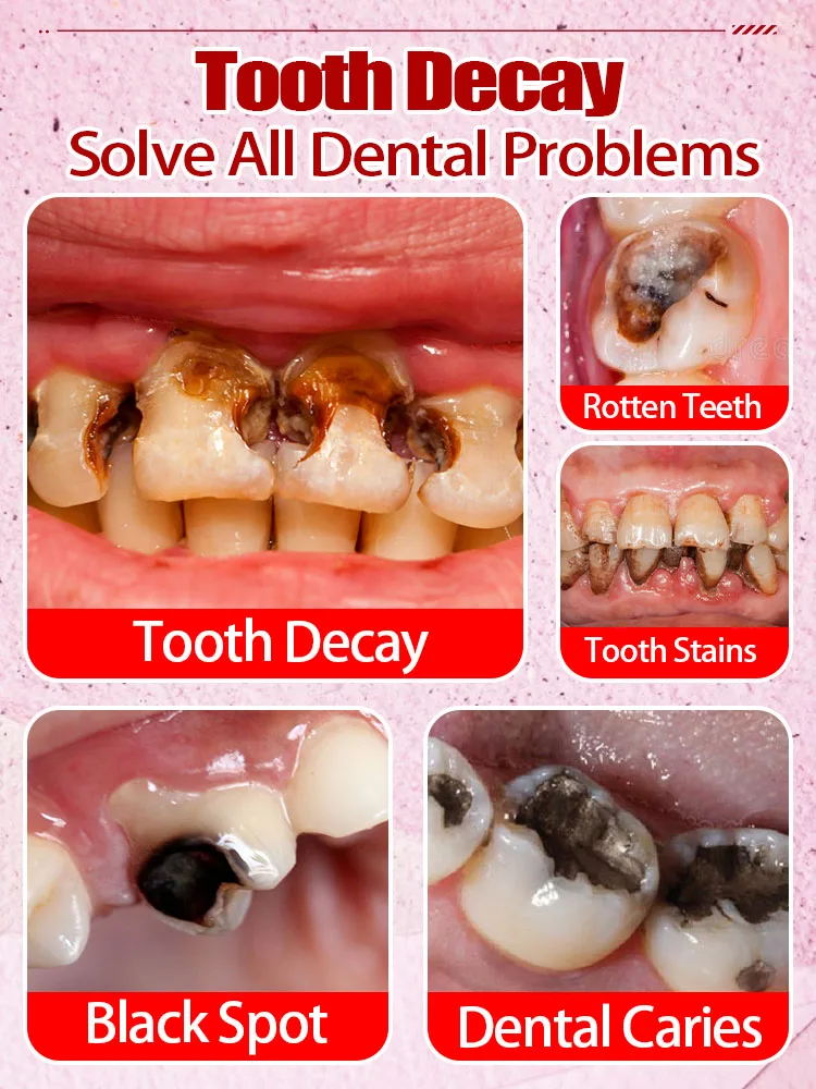 Dentifricio per la riparazione della carie