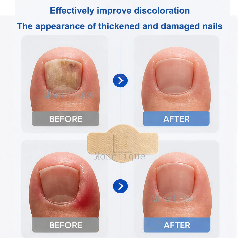 32/96PCS Nail Repair Stickers Portable Breathable Fungal Infection Toenails Embedded Growth Orthopedic Patch Foot Care Tools