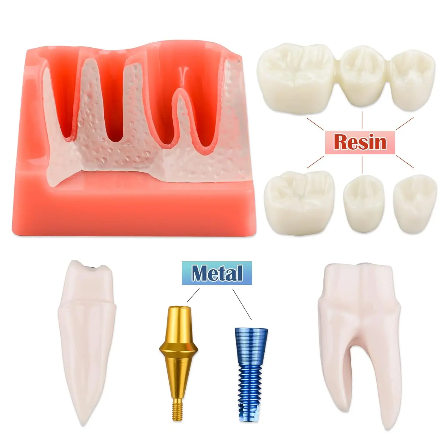 Dental Teeth Implant Model 4 Times Caries Comparsion Study Denture Models Analysis Crown Bridge Porcelain Restoration Study