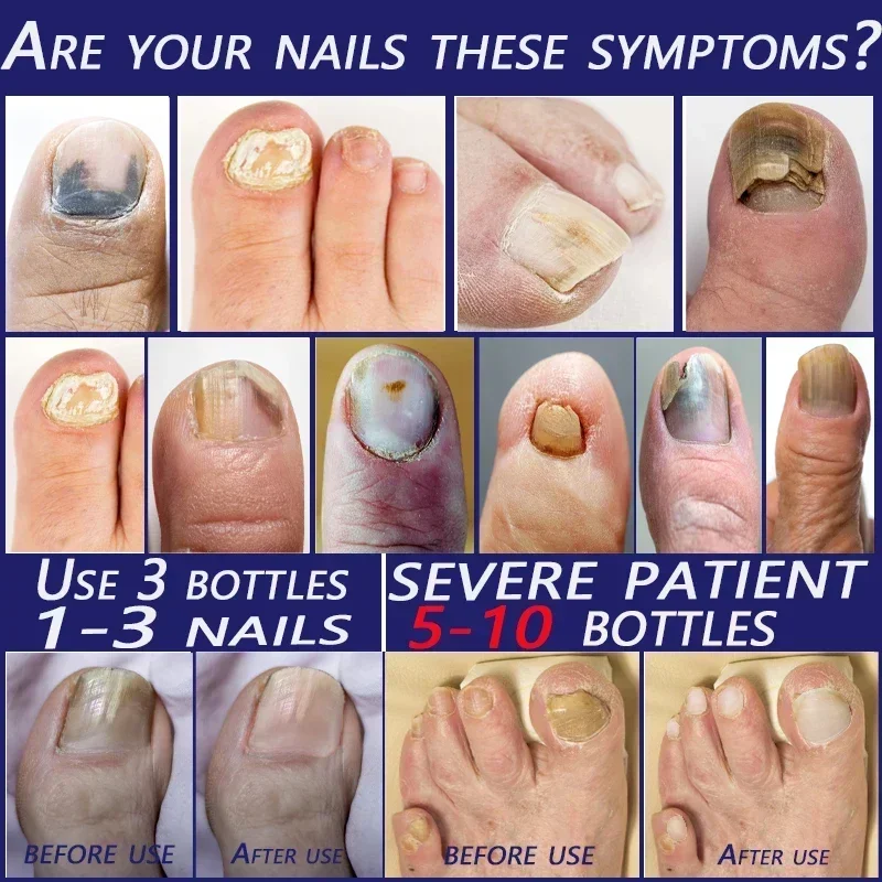 Traitement des ongles incarnés, élimination des ongles, paronyfriend, huile d'amitié, renouvellement des ongles, liquide, mauvais ongles, épaissir les ongles, solution de réparation des ongles doux