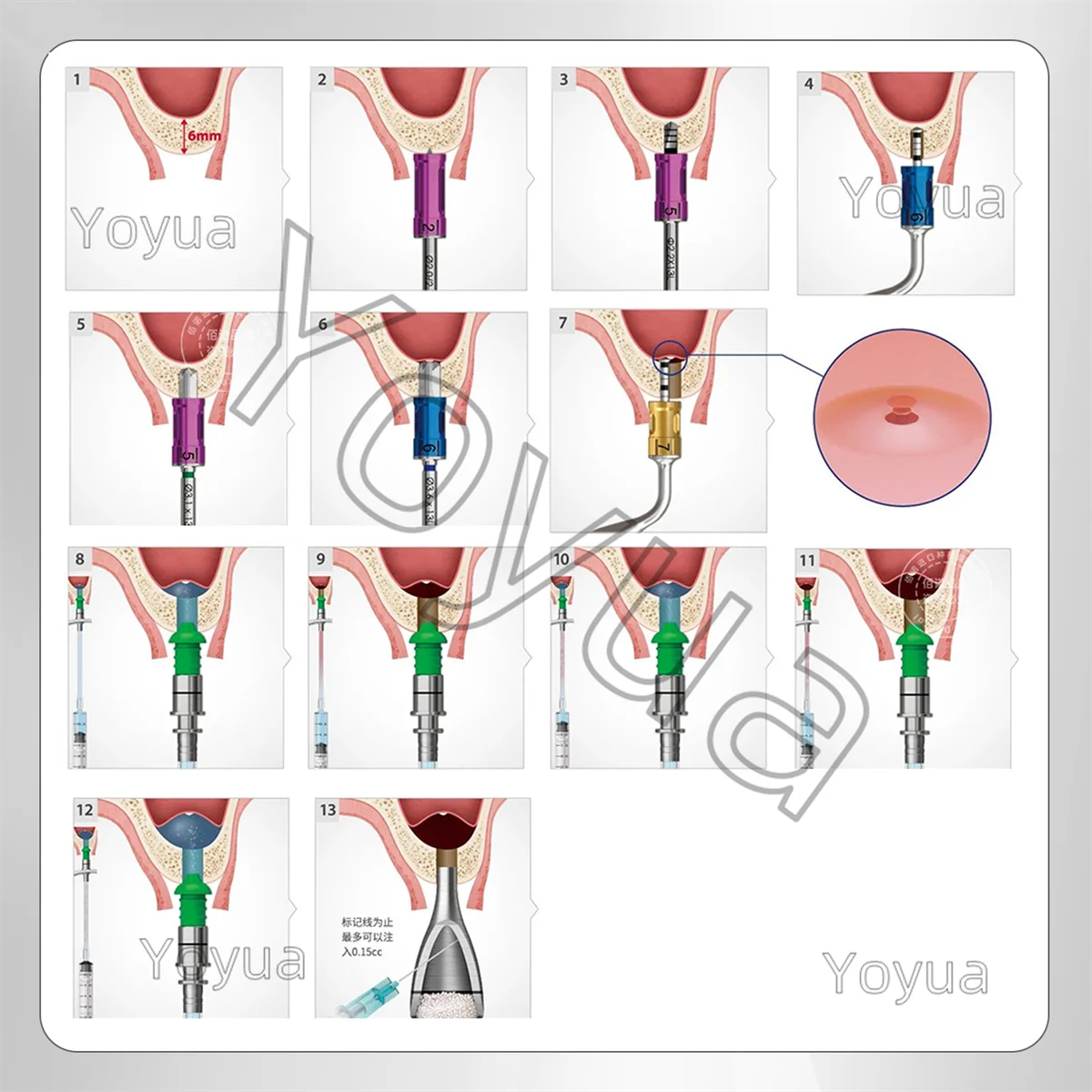 1 مجموعة زراعة الأسنان الفكري الجيوب الأنفية رفع أداة صندوق كريستال نهج الجيوب الأنفية عدة طبيب الأسنان زرع الأدوات الجراحية أدوات #3