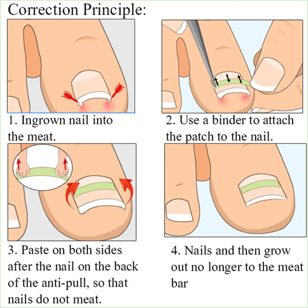 Clip de redressage des ongles incarnés, patchs élastiques de Correction des ongles incarnés, Patch de Correction Paronychia Acronyx, outil de soins des pieds