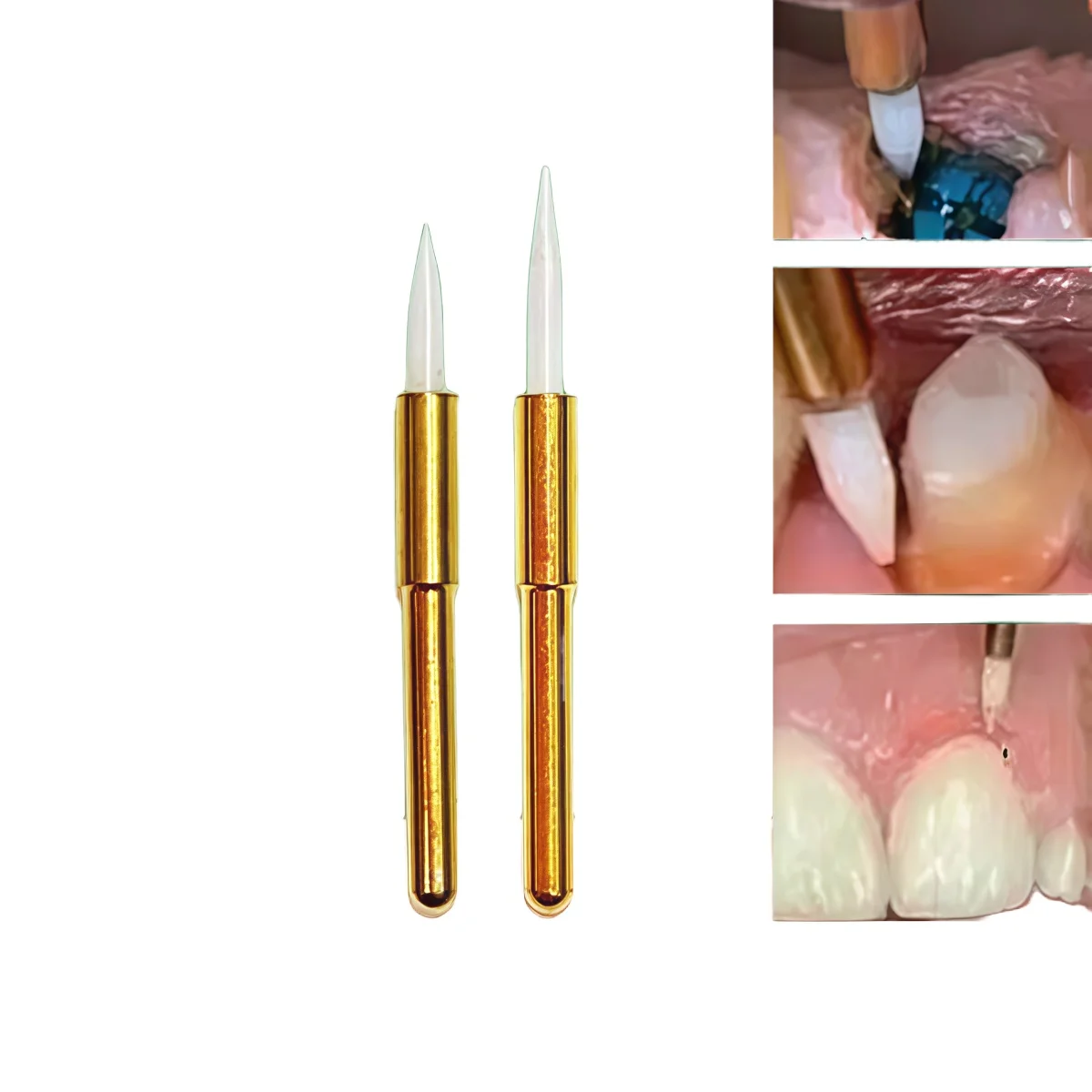 

1/2 шт., стоматологический бор, керамический триммер для мягких тканей для ретракции десен и гиперпластиковой резки десен, наконечник для зубного имплантата