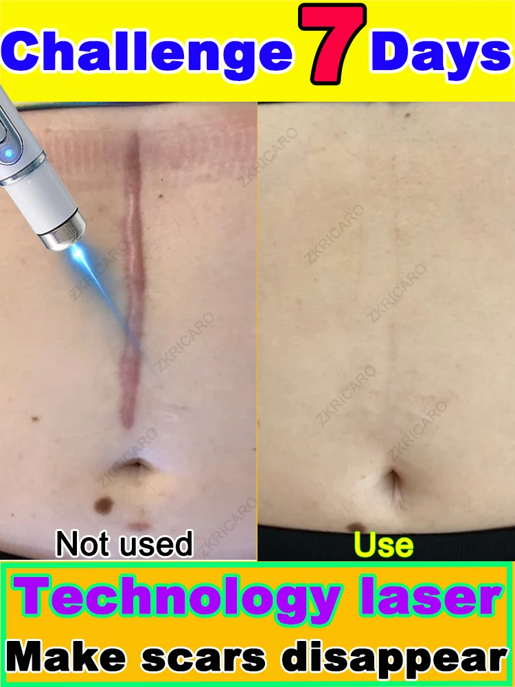 

Want to get rid of scars, try this