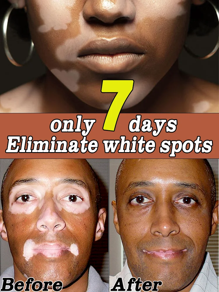 

крем для лечения витилиго, чтобы облегчить удаление белых пятен на коже