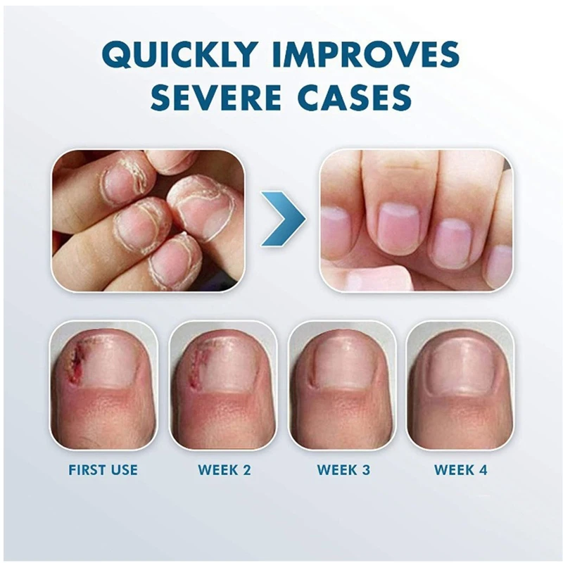 Leczenie grzybicy paznokci nóg, rozwiązanie przeciwgrzybicze Naprawa palców nóg i paznokci przypadku uszkodzonych, grubych