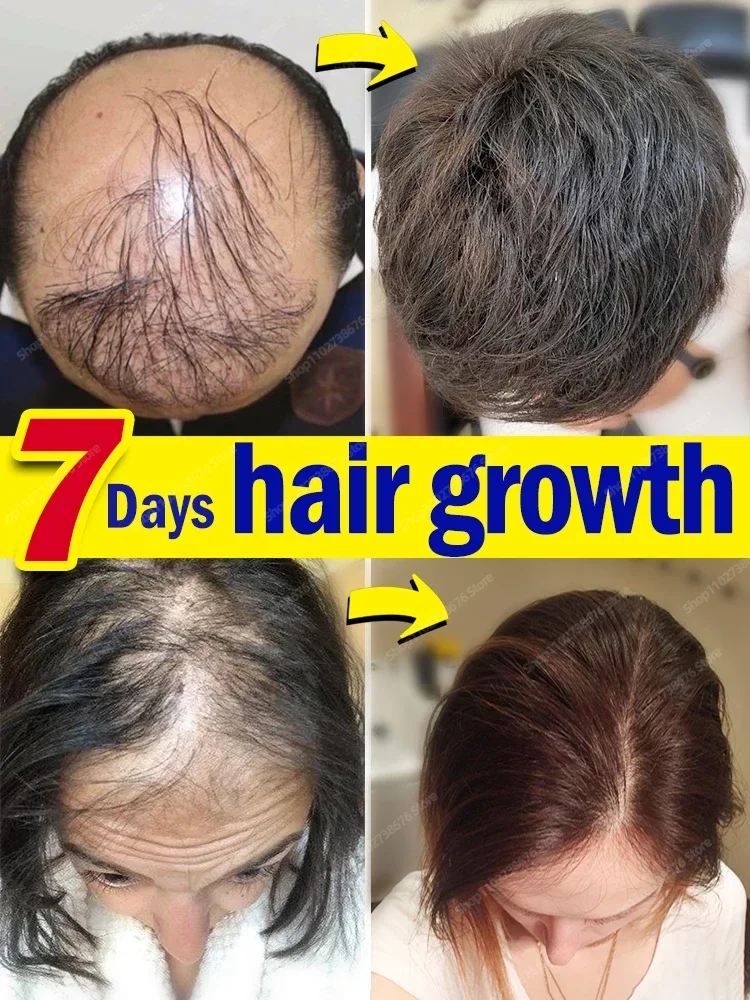 

O óleo de crescimento capilar faz o cabelo crescer rapidamente, repara eficazmente a calvície e a queda de cabelo hereditária