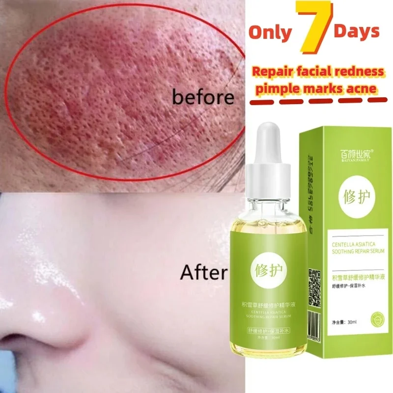 7 Day Repair Redness Serum Sooth Itching Sensitive Skin Improve Rosacea Shrink Pore Smooth Nourish Facial Skin Korean Cosmetics