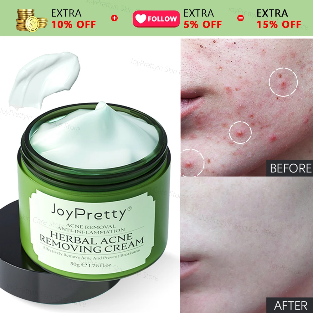 Herbal Acne Face Cream Pimple Marks Removal Oil Control Moisturizing Pockmark Smooth Facial Creams Skin Care Products JoyPretty