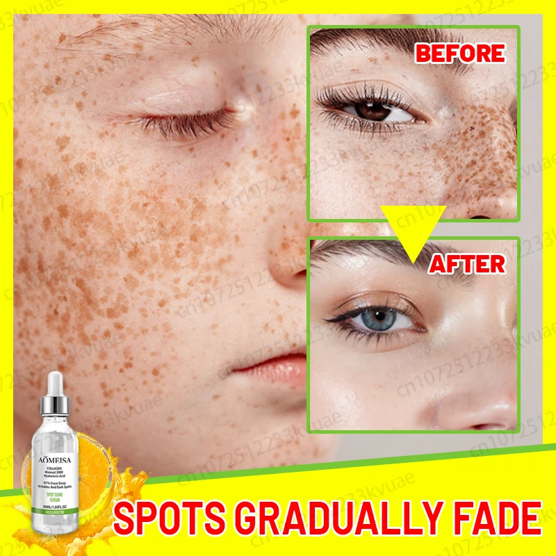 Freckles Removal Essence Remove Facial Spots Skin Dark Spot Remove Melasma Spots Sunspots Whitening And Freckle Removing Cream