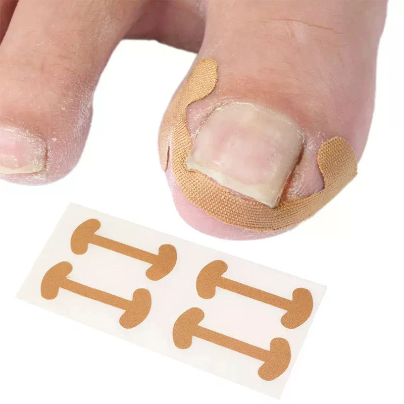 Professional Ingrown Toenail Foot Corrector Stickers Set Toe Nail Care Pedicure Tools Health Care Protects Paronychia Treatment