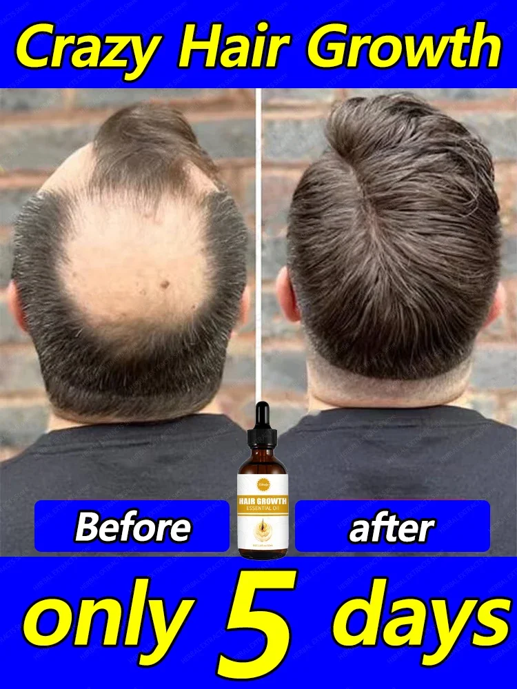 The best-selling hair growth product in Asia. From today, you will no longer be troubled by hair loss and baldness. Find your be