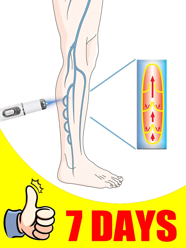 

Generation-2 Laser Says Goodbye To Spider Legs Varicose In 7 Days, Athletic Performance and Recovery