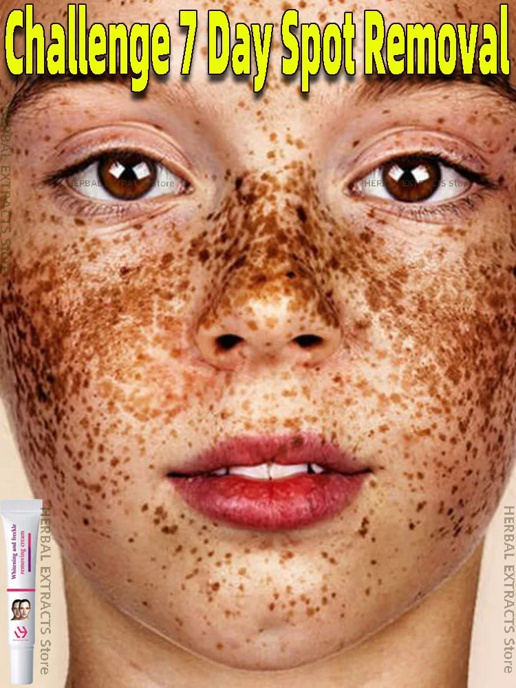 

Freckles Removal Cream Remove Facial Spots Skin Dark Spot Remove Melasma Age Spots Sunspots Whitening And Freckle Removing Cream