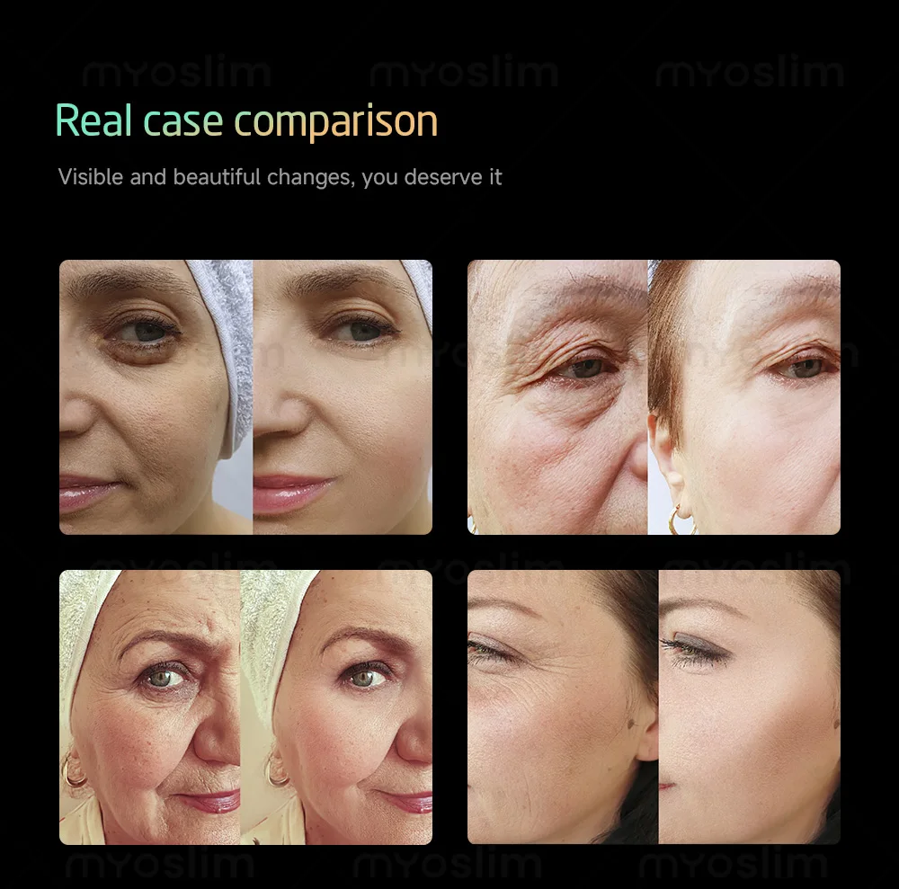 

EMS body Sculpt Machine 15 Tesla 6500W RF Fat Slimming Burning Muscle Stimulation Body Sculpting 15 Electromagnetic Therapy