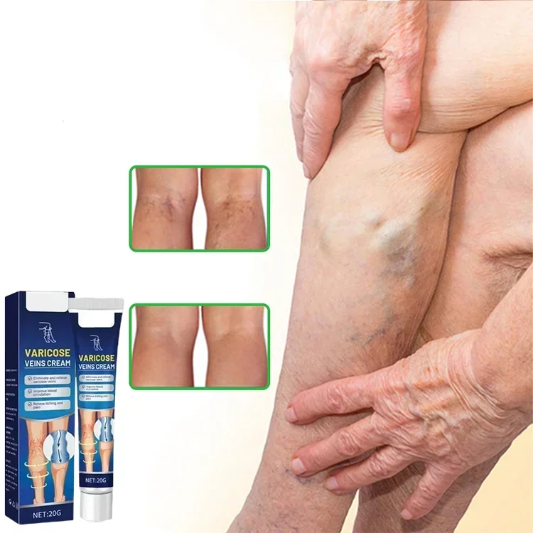 Varicose Veins Treatment Cream Vasculitis Phlebitis Spider Leg Ointment Plaster Blood Vessel Swelling Vascular Bulge Leg A081